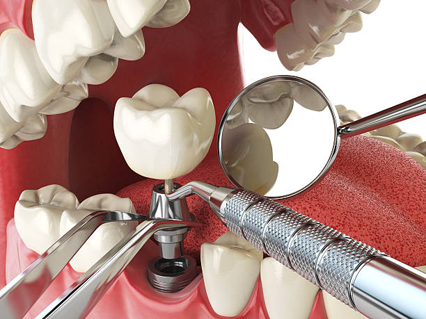 Best Emergency Root Canal Therapy in Gold Hill, OR